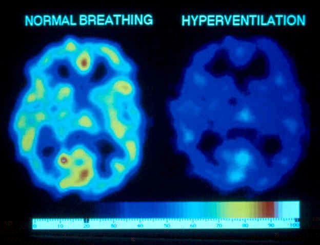 Ecco cosa succede al cervello di un soggetto iperventilante. Più i colori si avvicinano al nero e sono scuri, meno ossigeno è a disposizione delle cellule. 